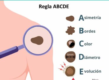 La dermatóloga Irati Allende explica qué es el callo solar y por qué es tan peligroso