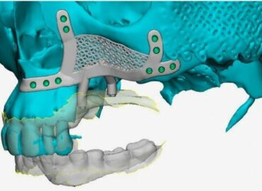 El Dr. Montesdeoca reconstruye el hueso maxilar superior gracias a unos implantes dentales subperiósticos