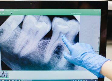 «Cada vez hay más evidencia de que la enfermedad periodontal, una inflamación crónica de las encías, puede estar relacionada con un mayor riesgo de sufrir infartos o accidentes cardiovasculares», doctor Carlos Mederos