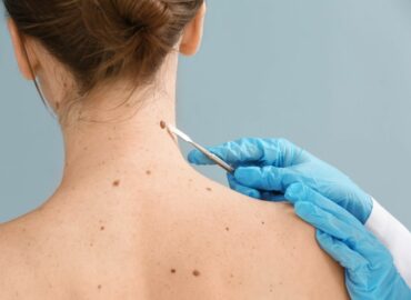 Dra. Ángela Estenaga, dermatóloga de Policlínica Gipuzkoa: «Hay que asumir que algunas pieles no pueden broncearse de forma saludable»