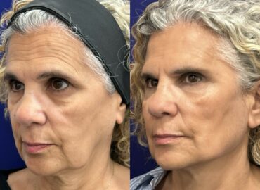 Global Face: nuevo protocolo integral del Dr. Ángel Martín para la recuperación de estructuras faciales, de la firmeza y elasticidad dérmica