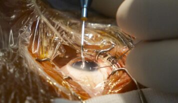 El codirector de FacoElche se somete en directo a la implantación bilateral de una lente diseñada con IA