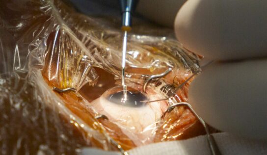 El codirector de FacoElche se somete en directo a la implantación bilateral de una lente diseñada con IA