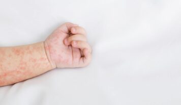 «Es vital mantener actualizado el calendario vacunal para evitar la propagación del sarampión»