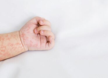 «Es vital mantener actualizado el calendario vacunal para evitar la propagación del sarampión»