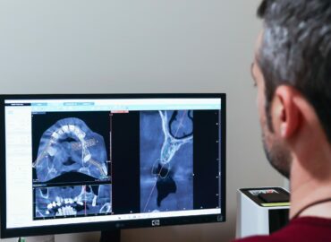 IOCantábrico analiza el papel de los implantes dentales en Gijón como solución avanzada para recuperar la sonrisa